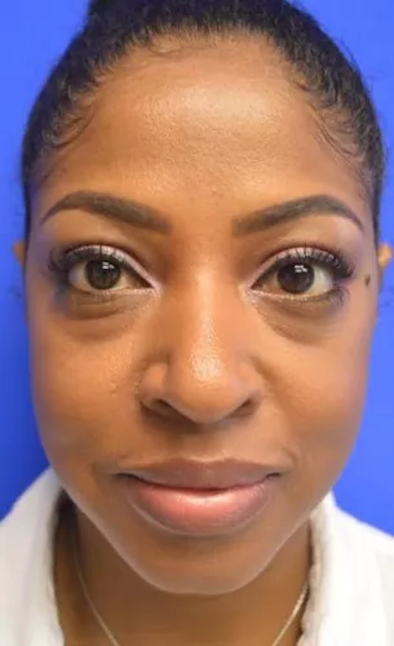 Lower Eyelid Before & After Gallery - Patient 814436 - Image 1