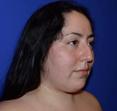 Rhinoplasty Before & After Gallery - Patient 345365 - Image 1