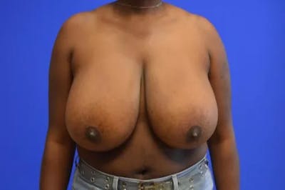 Breast Reduction with Lift Before & After Gallery - Patient 865993 - Image 1