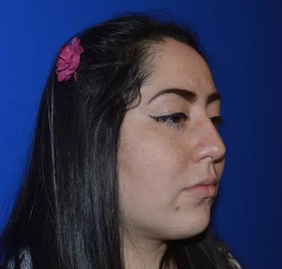 Rhinoplasty Before & After Gallery - Patient 345365 - Image 2