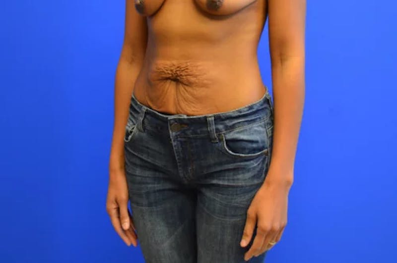 Drainless Tummy Tuck Before & After Gallery - Patient 103136 - Image 5