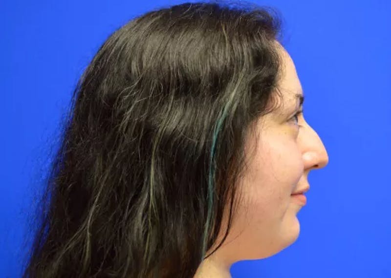 Rhinoplasty Before & After Gallery - Patient 345365 - Image 3