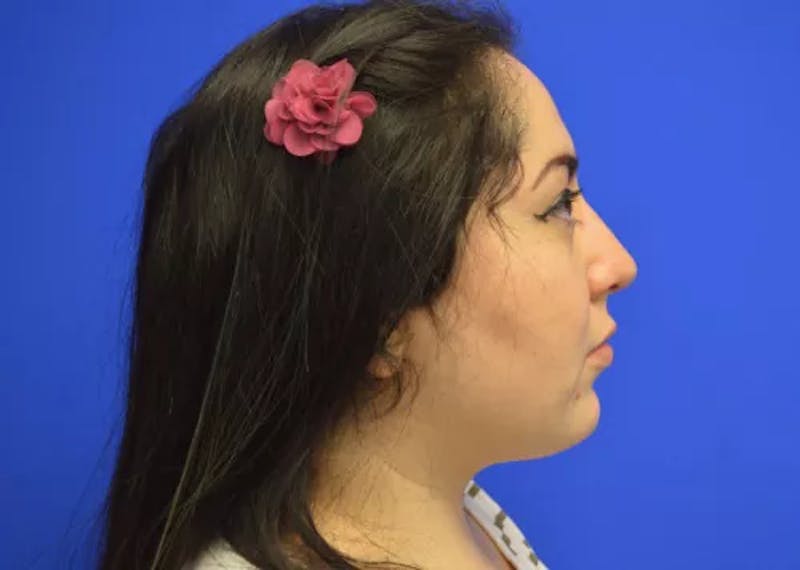 Rhinoplasty Before & After Gallery - Patient 345365 - Image 4