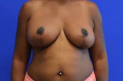 Breast Reduction with Lift Before & After Gallery - Patient 176181 - Image 2