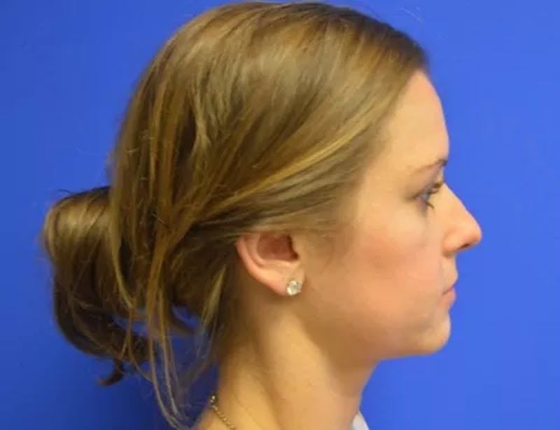 Rhinoplasty Before & After Gallery - Patient 177182 - Image 1