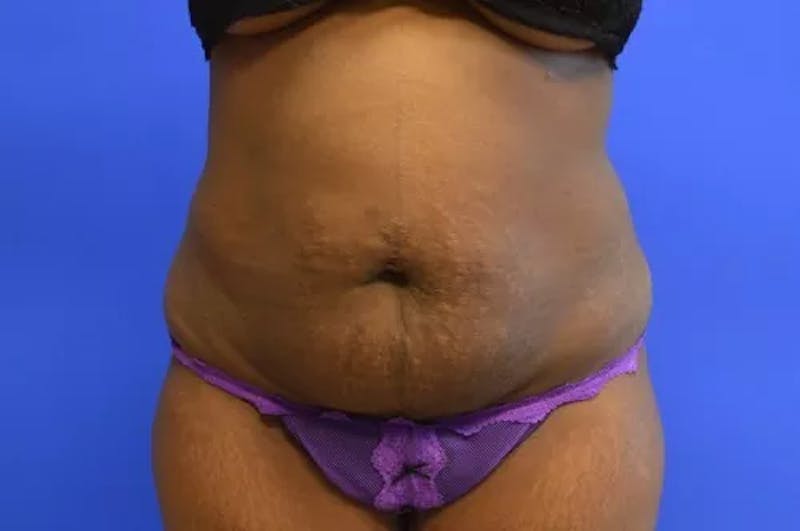 Drainless Tummy Tuck Before & After Gallery - Patient 131655 - Image 1