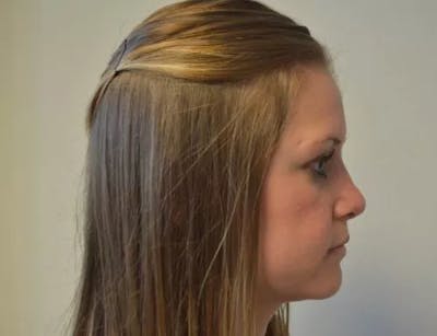 Rhinoplasty Before & After Gallery - Patient 177182 - Image 2