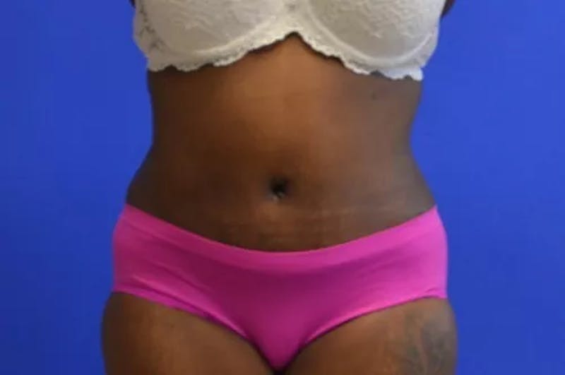 Drainless Tummy Tuck Before & After Gallery - Patient 131655 - Image 2