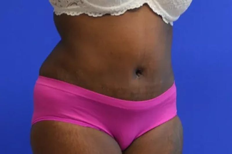 Drainless Tummy Tuck Before & After Gallery - Patient 131655 - Image 4