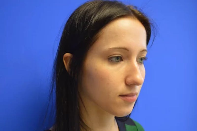 Rhinoplasty Before & After Gallery - Patient 268297 - Image 1