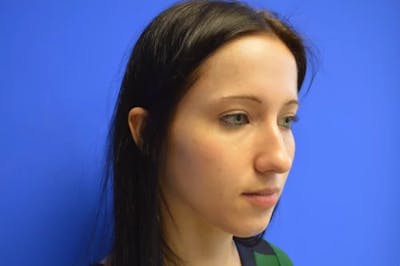 Rhinoplasty Before & After Gallery - Patient 268297 - Image 1