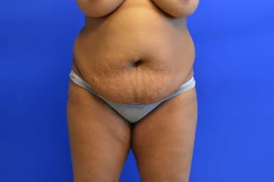 Drainless Tummy Tuck Before & After Gallery - Patient 683309 - Image 1