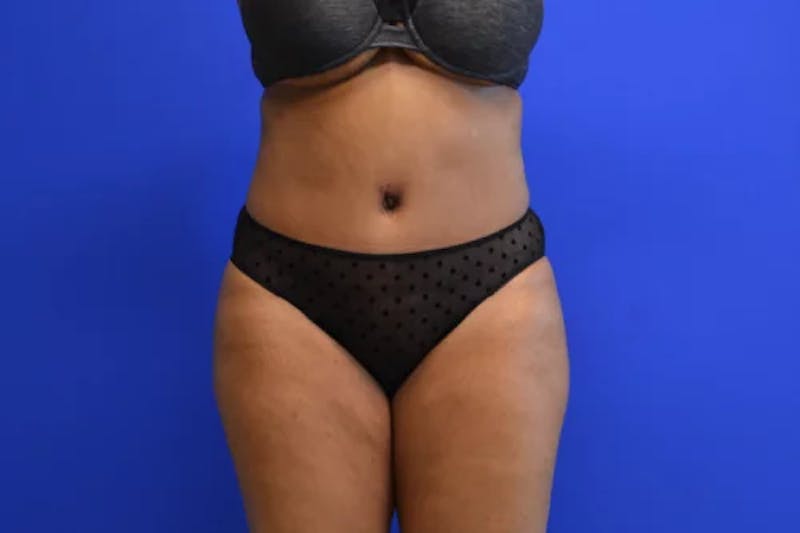 Drainless Tummy Tuck Before & After Gallery - Patient 683309 - Image 2