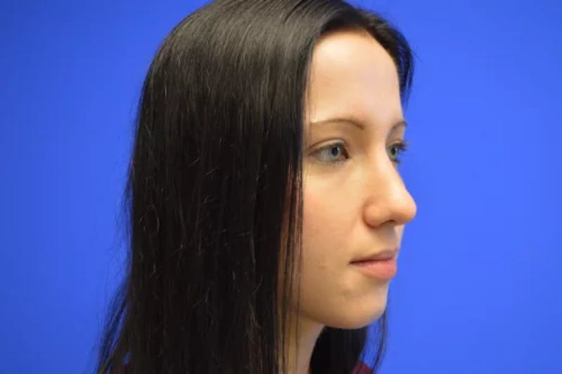 Rhinoplasty Before & After Gallery - Patient 268297 - Image 2