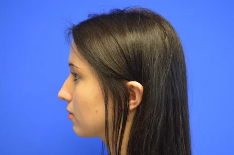 Rhinoplasty Before & After Gallery - Patient 268297 - Image 3