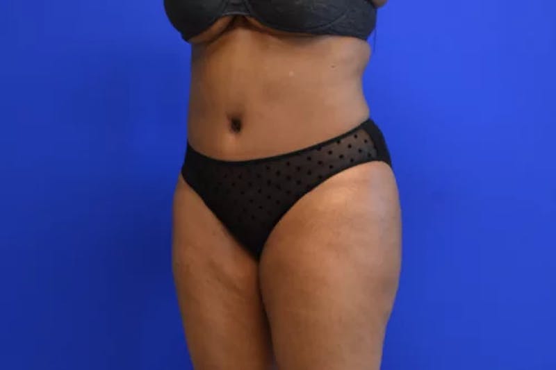 Drainless Tummy Tuck Before & After Gallery - Patient 683309 - Image 4