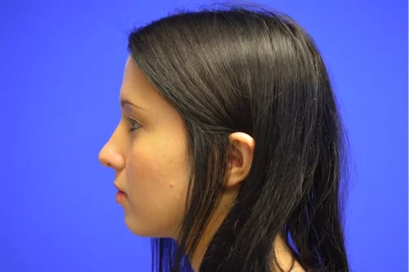 Rhinoplasty Before & After Gallery - Patient 268297 - Image 4
