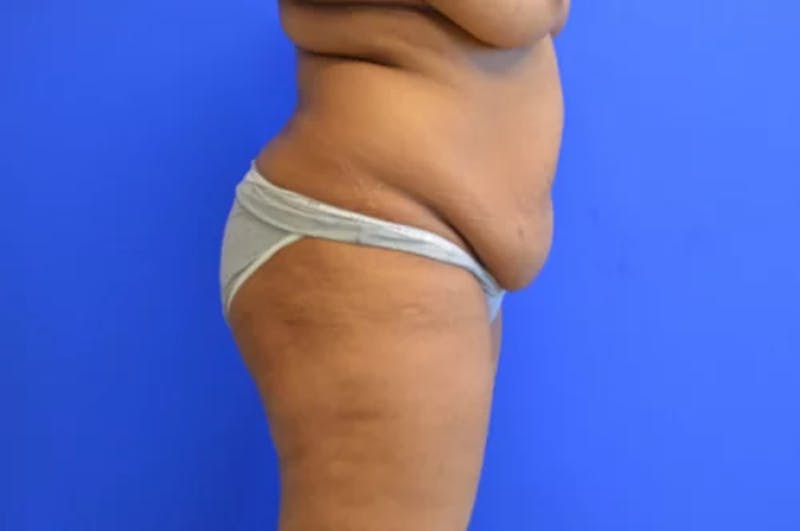 Drainless Tummy Tuck Before & After Gallery - Patient 683309 - Image 5