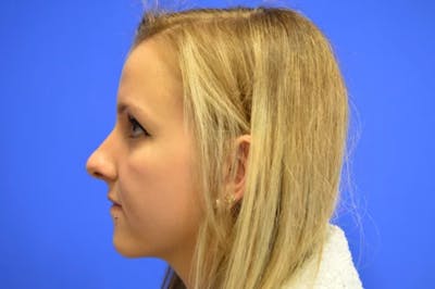 Rhinoplasty Before & After Gallery - Patient 272659 - Image 1