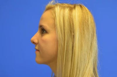 Rhinoplasty Before & After Gallery - Patient 272659 - Image 2
