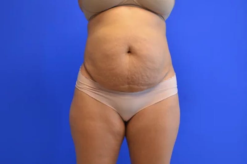 Drainless Tummy Tuck Before & After Gallery - Patient 330972 - Image 1