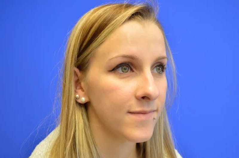 Rhinoplasty Before & After Gallery - Patient 272659 - Image 3