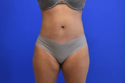 Drainless Tummy Tuck Before & After Gallery - Patient 330972 - Image 2