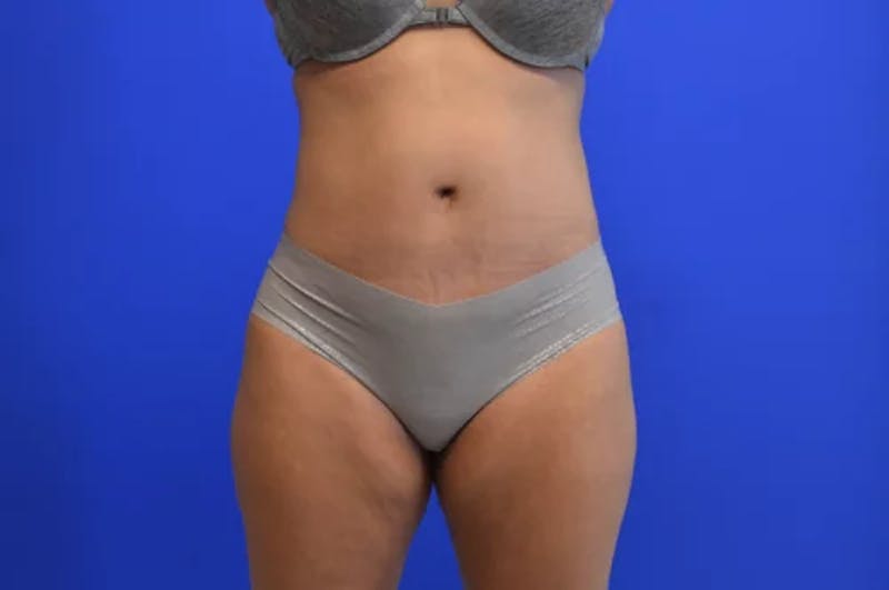 Drainless Tummy Tuck Before & After Gallery - Patient 330972 - Image 2