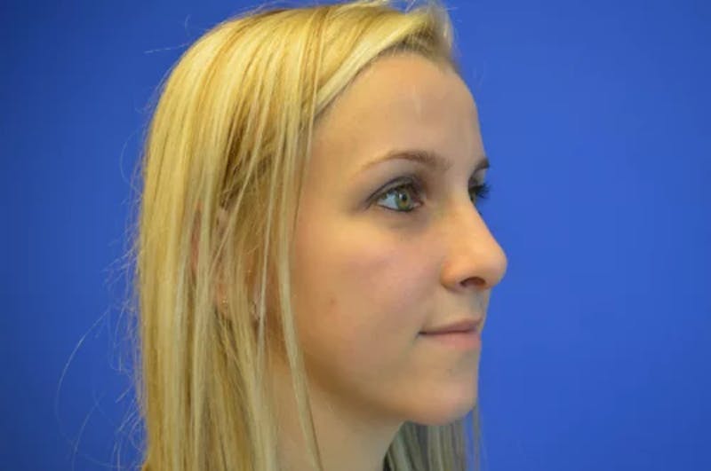Rhinoplasty Before & After Gallery - Patient 272659 - Image 4