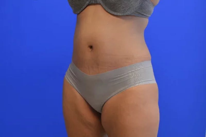 Drainless Tummy Tuck Before & After Gallery - Patient 330972 - Image 4