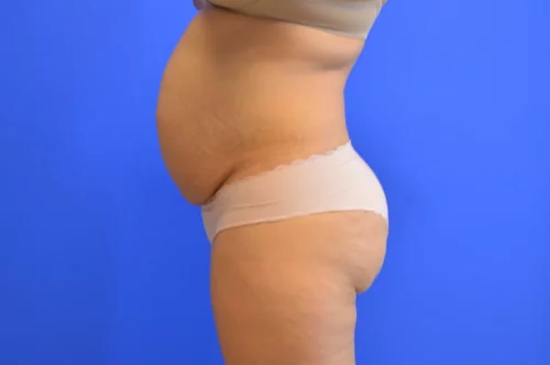 Drainless Tummy Tuck Before & After Gallery - Patient 330972 - Image 5