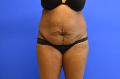Drainless Tummy Tuck Before & After Gallery - Patient 322327 - Image 1