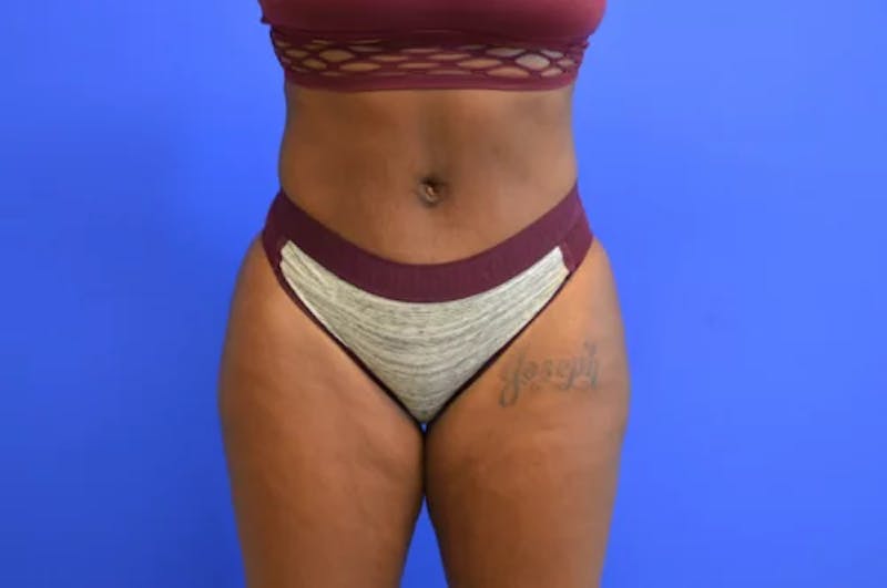 Drainless Tummy Tuck Before & After Gallery - Patient 322327 - Image 2