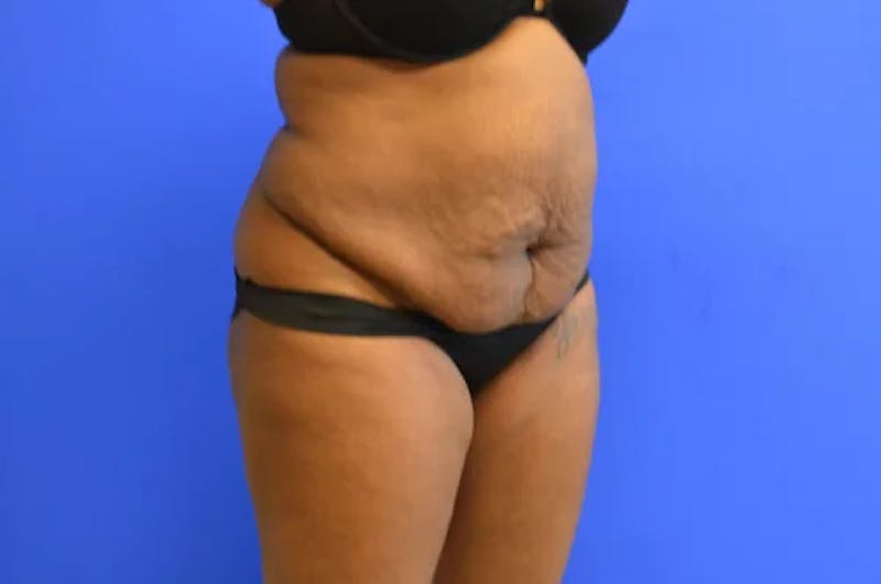 Drainless Tummy Tuck Before & After Gallery - Patient 322327 - Image 3