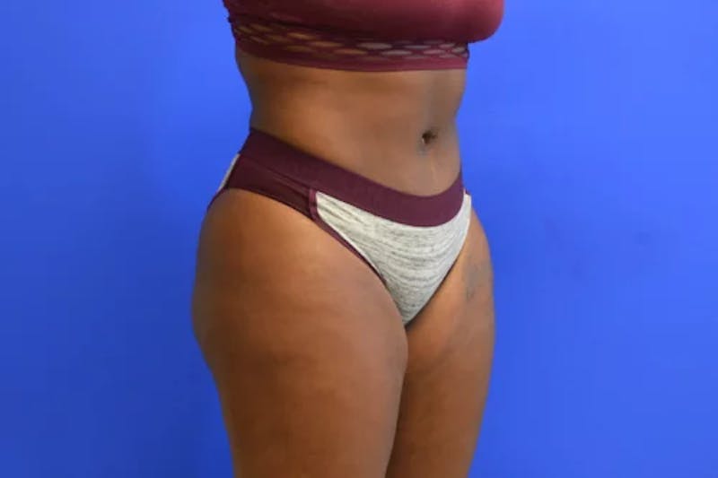 Drainless Tummy Tuck Before & After Gallery - Patient 322327 - Image 4