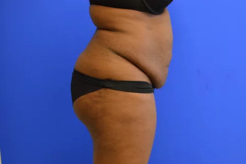Drainless Tummy Tuck Before & After Gallery - Patient 322327 - Image 5
