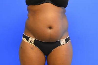 Drainless Tummy Tuck Before & After Gallery - Patient 124553 - Image 1
