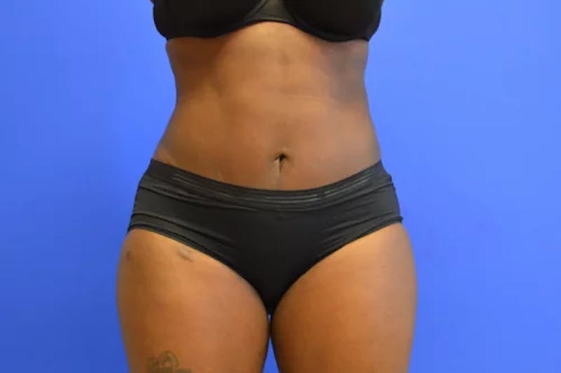 Drainless Tummy Tuck Before & After Gallery - Patient 124553 - Image 2