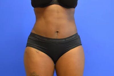 Drainless Tummy Tuck Before & After Gallery - Patient 124553 - Image 2
