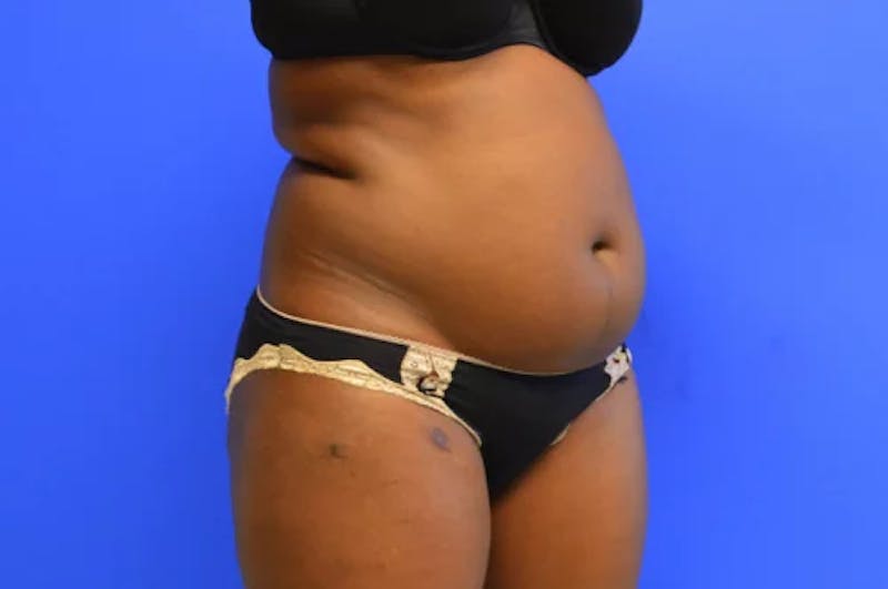 Drainless Tummy Tuck Before & After Gallery - Patient 124553 - Image 3