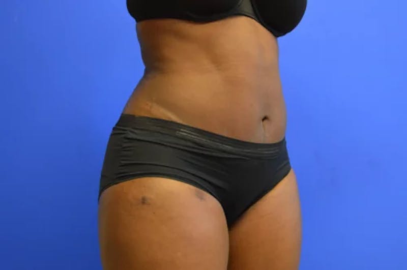 Drainless Tummy Tuck Before & After Gallery - Patient 124553 - Image 4