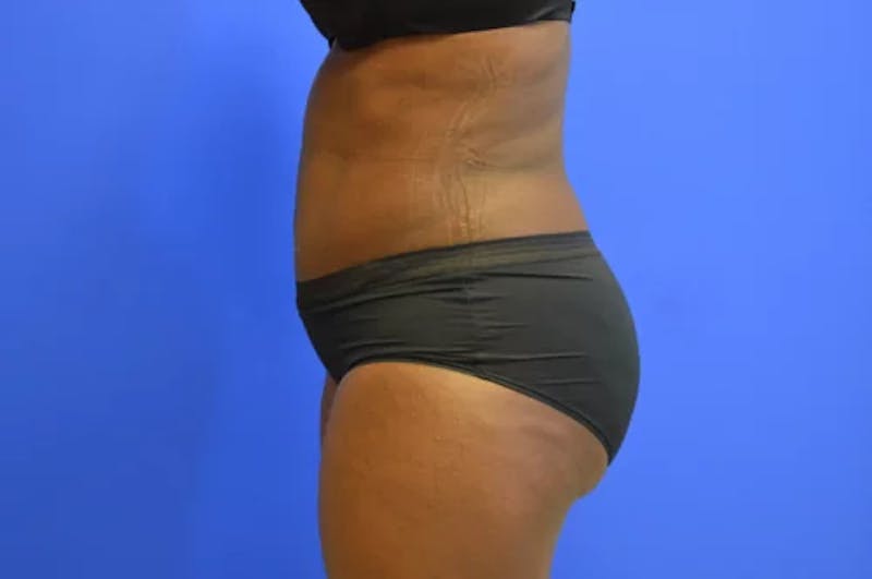 Drainless Tummy Tuck Before & After Gallery - Patient 124553 - Image 6