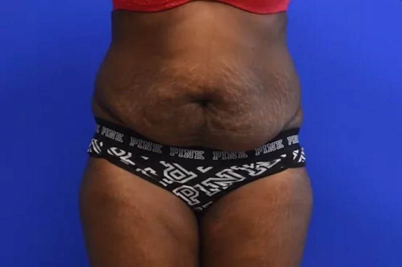 Drainless Tummy Tuck Before & After Gallery - Patient 112485 - Image 1
