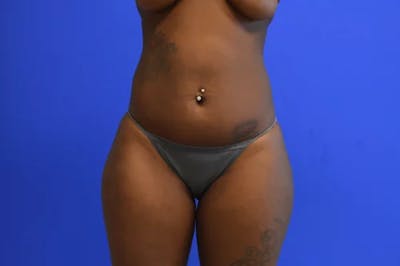Drainless Tummy Tuck Before & After Gallery - Patient 695499 - Image 1