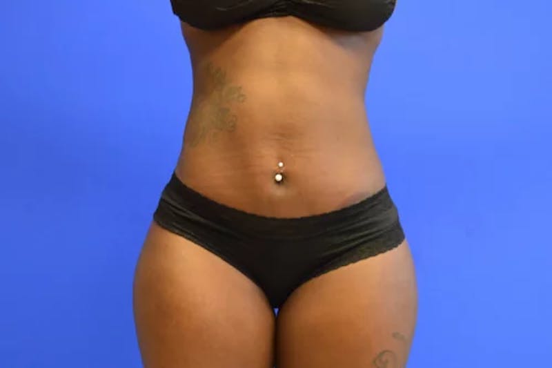 Drainless Tummy Tuck Before & After Gallery - Patient 695499 - Image 2