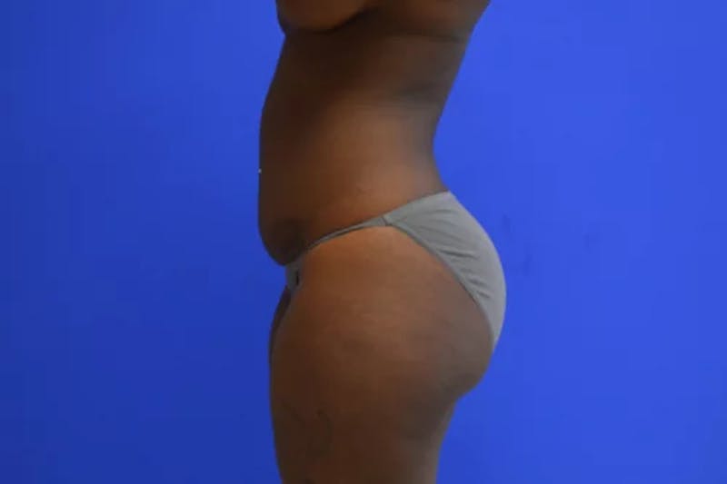 Drainless Tummy Tuck Before & After Gallery - Patient 695499 - Image 5