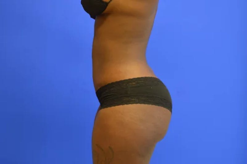Drainless Tummy Tuck Before & After Gallery - Patient 695499 - Image 6