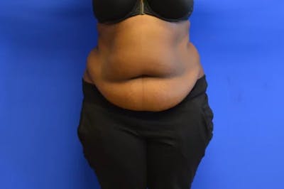 Drainless Tummy Tuck Before & After Gallery - Patient 238081 - Image 1