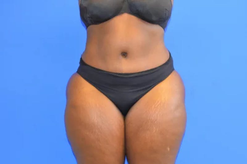 Drainless Tummy Tuck Before & After Gallery - Patient 238081 - Image 2