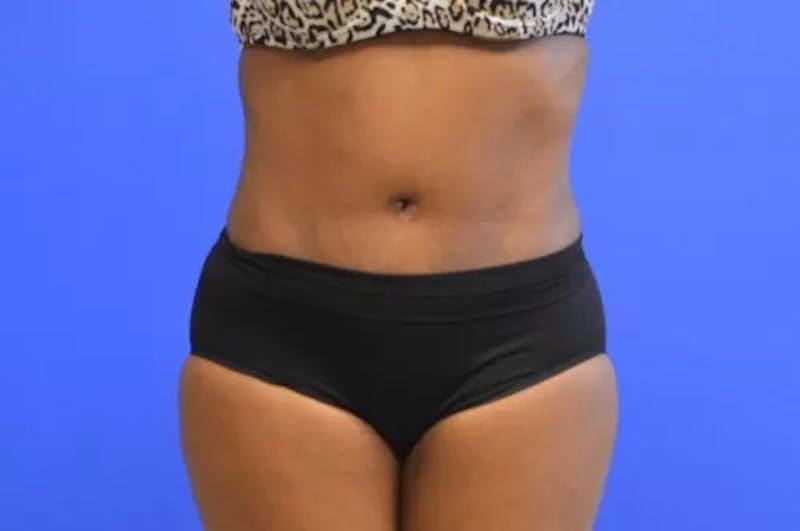 Drainless Tummy Tuck Before & After Gallery - Patient 437862 - Image 2